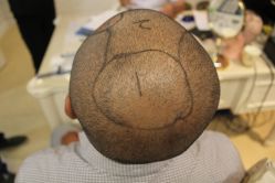 -大麦微针植发丨全国连锁