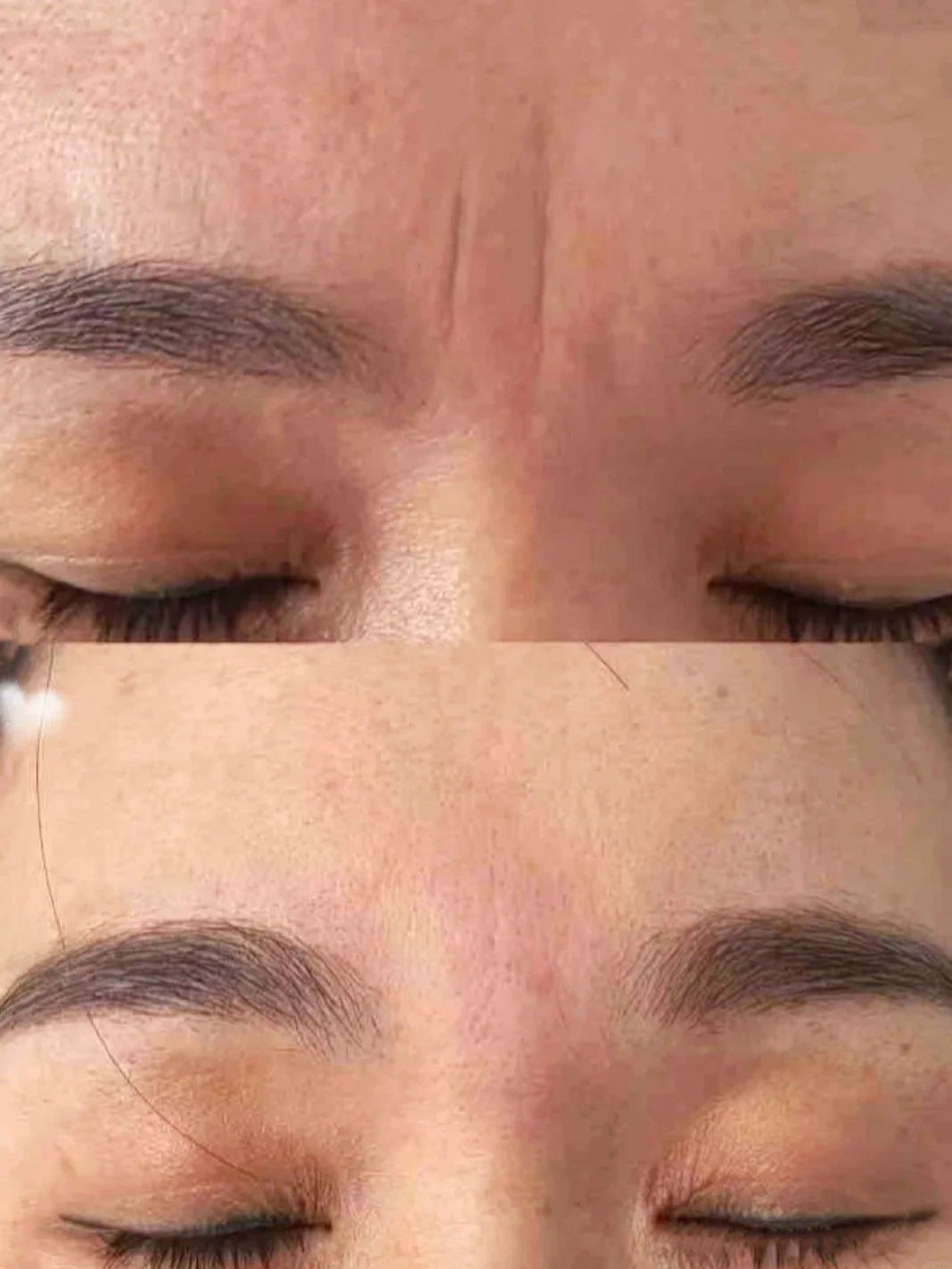 关于我的川字纹2个多月的变化