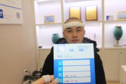 点击看大图 -大麦微针植发丨全国连锁