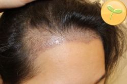 -大麦微针植发丨全国连锁