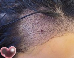 -大麦微针植发丨全国连锁