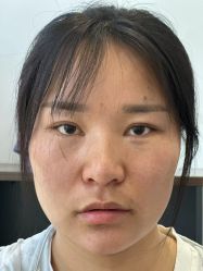 体验后-苏州卫康美容医院