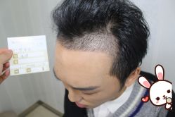 -大麦微针植发丨全国连锁