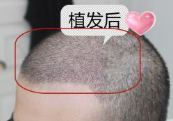 -大麦微针植发丨全国连锁