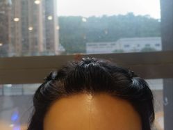 -碧莲盛·不剃发植发