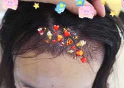 -大麦微针植发全国连锁