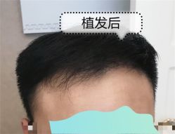 -大麦微针植发全国连锁