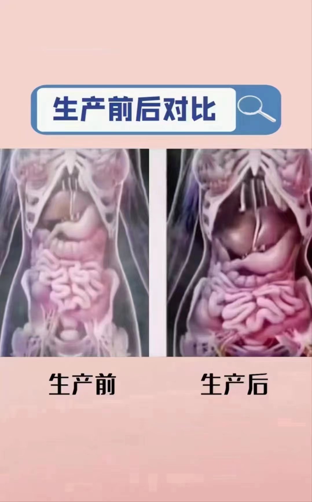 n因为生完孩子   子宫腾空  内脏失去支撑\\n随之子宫内脏下垂\\n