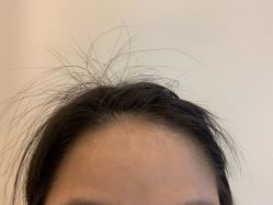 -大麦微针植发丨全国连锁