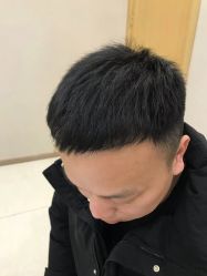 -大麦微针植发丨全国连锁