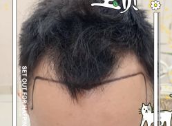 -大麦微针植发全国连锁