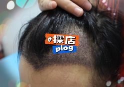 -大麦微针植发全国连锁