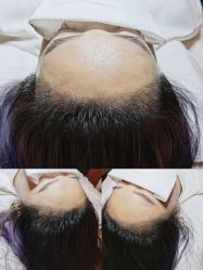 点击看大图 -西施无菌半永久纹绣眉眼影唇轻增发纹发际线