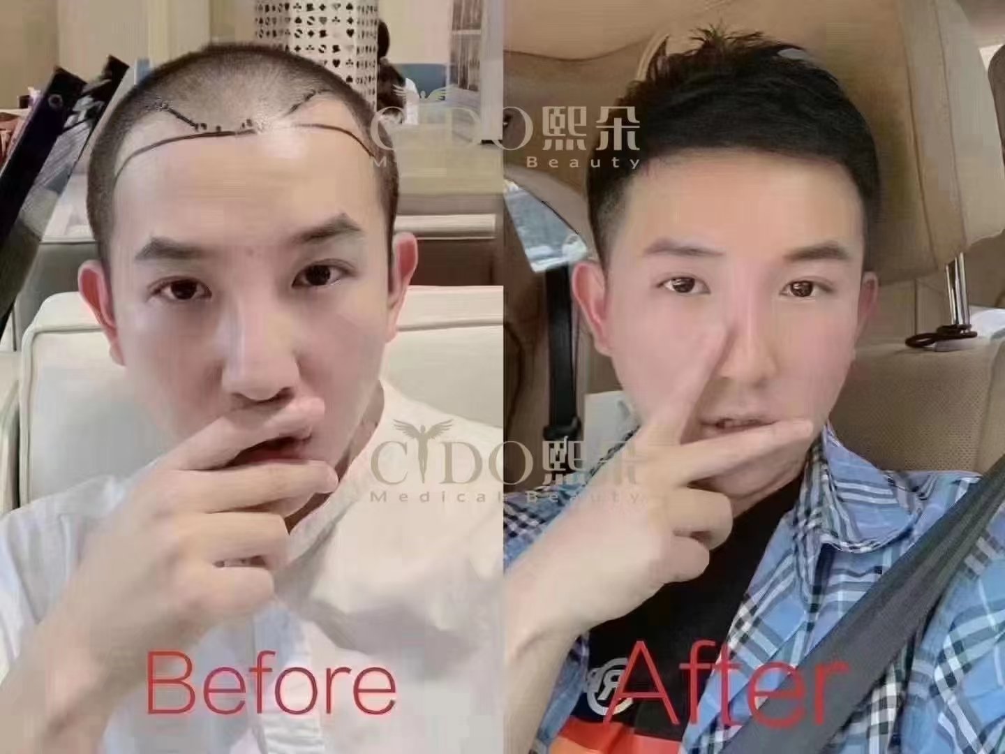 济南aht植发(济南哪里植发专业)