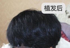 -大麦微针植发全国连锁