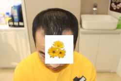 -大麦微针植发丨全国连锁