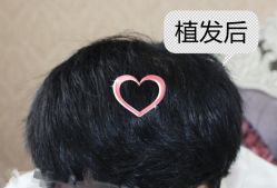 -大麦微针植发丨全国连锁