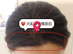 -大麦微针植发全国连锁