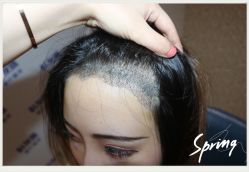 点击看大图 -大麦微针植发全国连锁