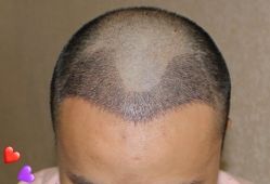 -大麦微针植发丨全国连锁