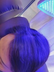 -碧莲盛·不剃发植发