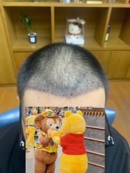 -大麦微针植发全国连锁