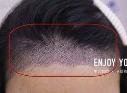 -大麦微针植发全国连锁