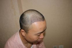 -大麦微针植发丨全国连锁