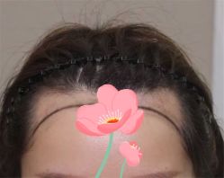 点击看大图 -大麦微针植发全国连锁