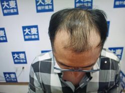 -大麦微针植发丨全国连锁