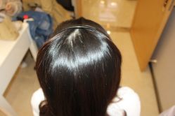 -大麦微针植发丨全国连锁