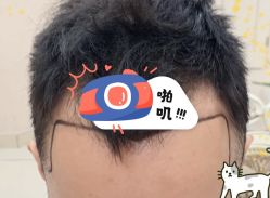 -大麦微针植发全国连锁