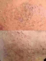 -瑶芳清颜草本祛痘