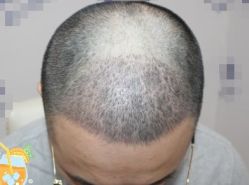 -大麦微针植发丨全国连锁