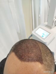 体验后-大麦微针植发丨全国连锁