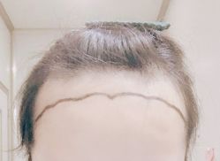 -大麦微针植发全国连锁