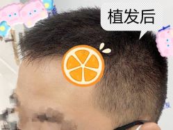 -大麦微针植发全国连锁