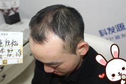 -大麦微针植发丨全国连锁