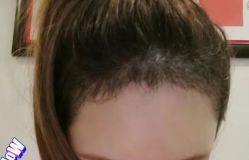 -大麦微针植发丨全国连锁