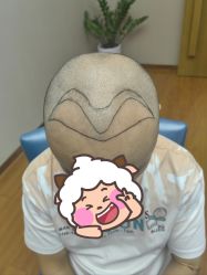 -大麦微针植发全国连锁