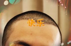 -大麦微针植发全国连锁