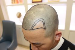 -大麦微针植发丨全国连锁