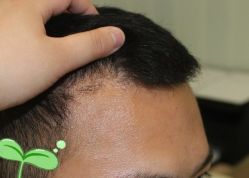 -大麦微针植发丨全国连锁