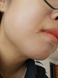 体验后-清疣美疣·痣·斑净肤中心