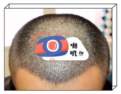 -大麦微针植发全国连锁