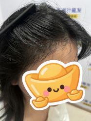 -大麦微针植发丨全国连锁