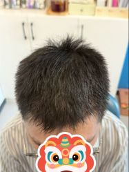 点击看大图 -大麦微针植发全国连锁