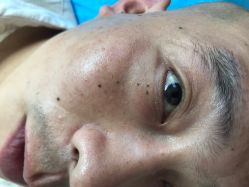 -美丽人生祛斑扁平疣汗管瘤中心