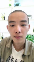 点击看大图 -大麦微针植发丨全国连锁