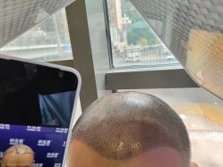 -碧莲盛·不剃发植发